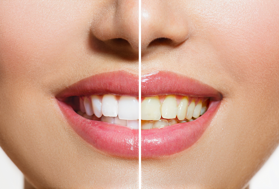 Teeth Whitening - Dentist Charlotte NC